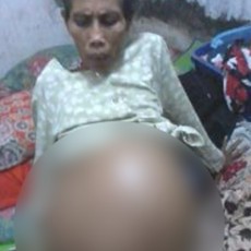 Tak Tersentuh Medis, Tumor di Perut Nasiya Semakin Membesar