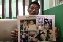 Diduga Atresia Bilier, Anak Sopir Fuso dari Lampung Selatan Dirawat RSCM