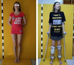 Agar Tambah Tinggi, Wanita Ini Jalani Prosedur Patahkan Kaki