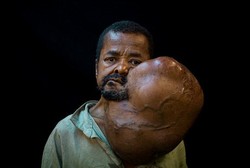 Setelah 40 Tahun, Tumor Raksasa di Leher Pria Ini Akhirnya Dioperasi