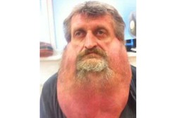 Idap Kondisi Langka, Ada Tumor 6,3 Kg di Wajah Pria 47 Tahun Asal Slovakia