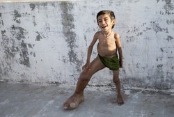 Usia 4 Tahun, Bocah di India Punya Kaki Raksasa Seberat 5,4 Kg