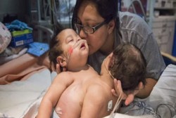 Sukses Besar, Pemisahan Kembar Siam Perut dan Dada Pertama di Dunia