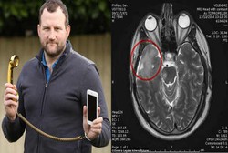 6 Jam Pakai Ponsel Tiap Hari, Pria Ini Kena Tumor Otak