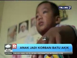 Cincin Batu Akik Tersangkut di Jari Anak Hingga Bengkak