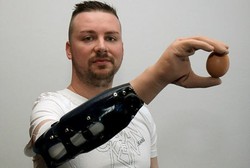 Cedera Berat, Tangan Para Pria Ini Diubah Jadi Bionik