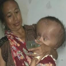 Penderita Hidrosefalus di Jember Belum Tersentuh Bantuan