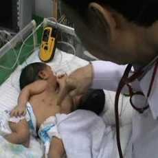 Kembar Siam Sahrini-Sahrina Meninggal Setelah Dirawat 7 Bulan