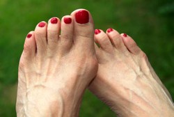 Hallux Valgus, Saat Jempol Kaki Bengkok Gara-gara High Heels