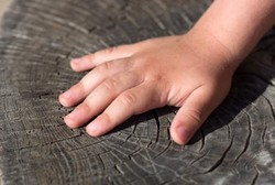 Daftar Kondisi Kesehatan yang Bisa Diprediksi dari Keadaan Tangan (2)