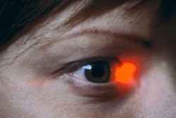 Lasik Hanya Bisa Dilakukan di Usia 20-40 Tahun? Ah Belum Tentu