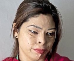 Wajah Wanita Ini Berubah Jadi Tidak Berbentuk Setelah Disiram Cairan Asam