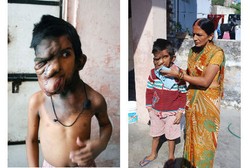 Kasihan, Bocah Ini Dijauhi Teman-temannya karena Tumor Besar di Wajah