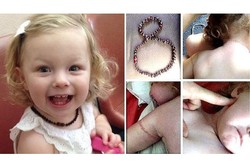 Leher Terlilit Kalung, Balita 21 Bulan Sempat Sulit Bernapas Saat Tidur