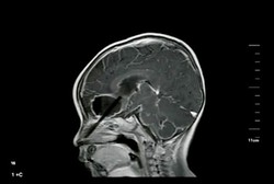 Ya Ampun! Ada Sumpit Tertinggal di Kepala Bocah 1 Tahun Selama 10 Hari