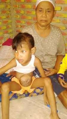 Gadis Cilik dengan Benjolan di Perut Ternyata Juga Alami Kelainan Jantung