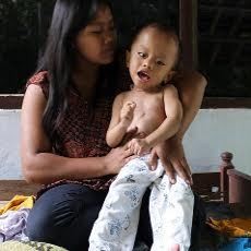 Dua Pasien Gizi Buruk di Blitar Memprihatinkan