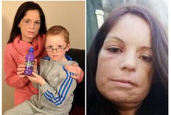 Lisa Ketahuan Idap Kanker Mulut Saat Giginya Retak karena Buka Tutup Botol