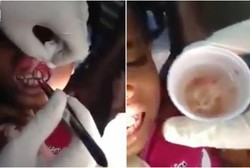 Gusi Bengkak, Ternyata Belasan Belatung Bersemayam di Mulut Bocah Ini