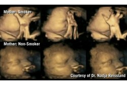 Hasil USG Ini Tunjukkan Kondisi Janin dari Ibu Perokok dan Non-perokok