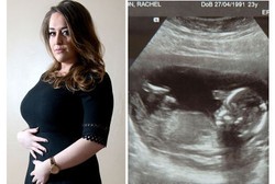 Dinyatakan Keguguran, 3 Minggu Kemudian Janin Rachel Ternyata Masih Hidup