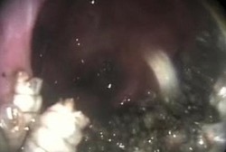 Mimisan 7 Hari, Ternyata Ada 100 Belatung Hidup di Hidung Pria Ini