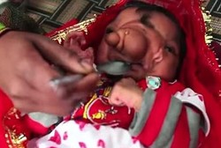 Bayi di India Lahir dengan Tonjolan di Hidung yang Mirip Belalai