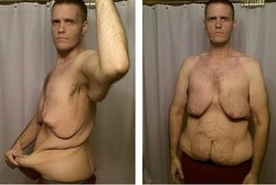 Turun Bobot 166 Kg, Brian Galang Dana untuk Hilangkan Gelambir di Kulit