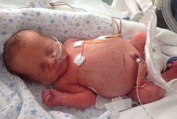 Kisah Miley, Bayi yang Perutnya Bengkak Sejak Masih di Kandungan