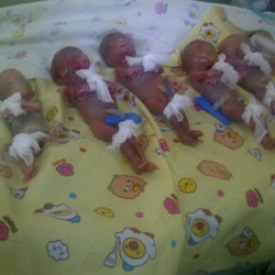 Bayi Kembar Lima Lahir di Bukittinggi, Meninggal usai Persalinan
