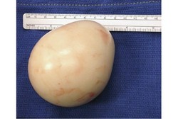 Selama 20 Tahun, Ada Gumpalan Lemak Sebesar 10 Cm di Kandung Kemih Pria Ini