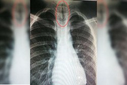 Dikira Radang, Ternyata Ada Lintah di Tenggorokan Bocah Ini