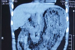 Kurus dan Kurang Gizi, Ternyata Ada Rambut Seberat 2 Kg di Perut Bocah Ini