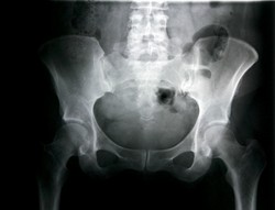 Hati-hati Ini Dampaknya Jika Anda Mengalami Cedera Selangkangan