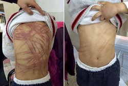 Pekerjaan Rumah Tak Selesai, Tubuh Bocah Ini Dipenuhi Bekas Cambukan