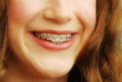 Gigi Sudah Rapi Tapi Ingin Gaya Pakai Behel, Adakah Dampaknya?