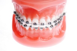 Kawat Gigi Bisa Bikin Gampang Sariawan dan Gigi Bolong? Ini Kata Dokter