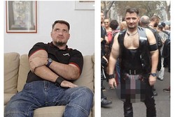 Gunakan Silikon, Penis Pria di Jerman Membesar dan Beratnya Mencapai 4 Kg