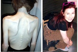 Idap Anoreksia, Beth Cuma Konsumsi Teh dan Kopi Hingga Bobotnya 25 Kg