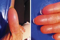 Efek Samping Aneh dari Kemoterapi, Wanita Ini Kehilangan Sidik Jari