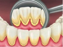 Pakai Trik Ini Untuk Cegah Plak Gigi Kembali Terbentuk