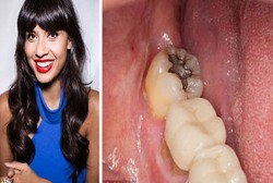 Langka, Jameela Diduga Keracunan Merkuri karena Tambalan Gigi