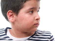 Bukan Dianiaya, Bercak Merah di Kulit Bocah Ini Muncul karena Kondisi Langka