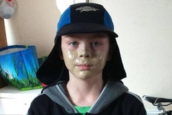 Harus Pakai Krim Khusus karena Sakit Langka, James Malah Di-bully