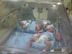 Dokter RSUZA Tangani Bayi Kembar Dempet Kepala Asal Aceh Tenggara