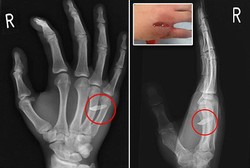 Hii! Gigi Tertancap di Tangan Remaja Ini Setelah Meninju Wajah Adiknya