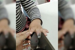 Gara-gara Nenek Pasang Perban Terlalu Kuat, Jari Balita Ini Diamputasi