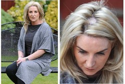 Kecanduan Tanning Sejak Usia 15 Tahun, Wanita Ini Kena Kanker Kulit