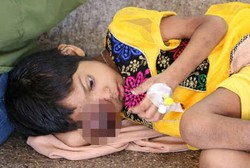 Dikira Jerawat dan Dibiarkan, Mata Bocah Ini Bengkak Karena Kanker Langka