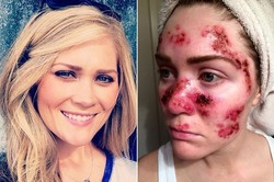 Keranjingan Pakai Sunbed, Wajah Gadis Ini Seperti Alami Luka Bakar